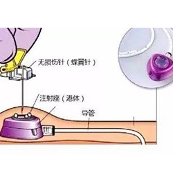 植入式给药装置.jpg